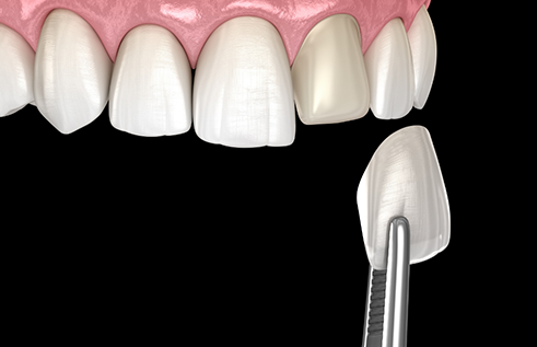 Illustration of a veneer being placed over the front of a tooth