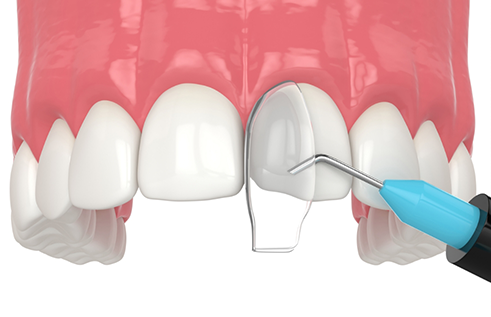 Illustration of bonding material being applied to a chipped tooth