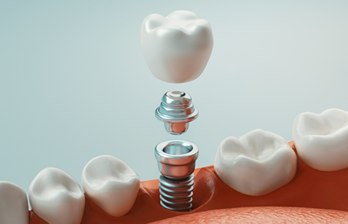 Illustration of a dental crown being placed onto a dental implant