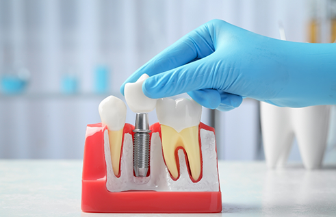 Hand placing a dental crown over a model of a dental implant