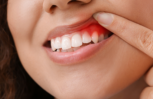 Person pointing to a red spot in their gums