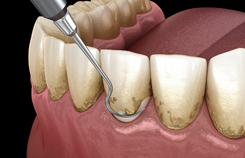 Illustration of a dental scaler clearing tartar buildup from the gumline