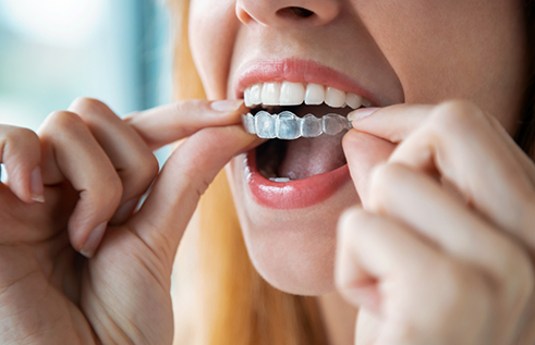 Blonde woman placing an Invisalign aligner over her teeth