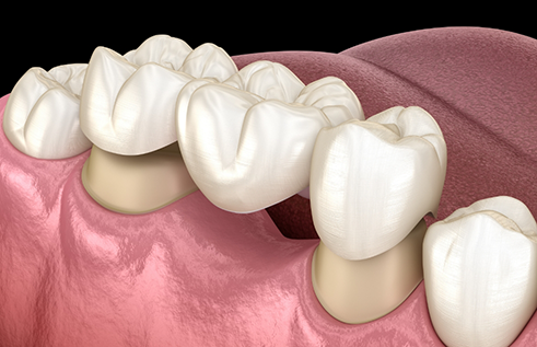 Illustration of a dental bridge filling the gap between two missing teeth