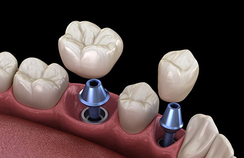 Illustration of two dental crowns being placed onto two dental implants