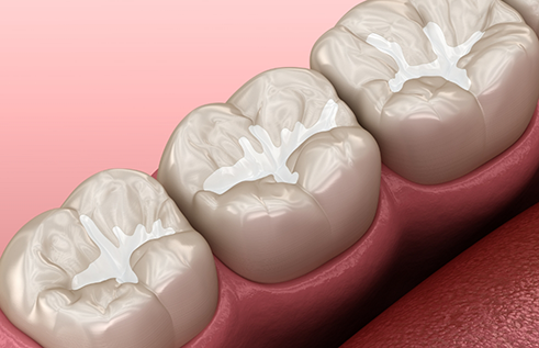 Illustrated row of teeth with dental sealants