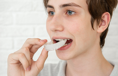 Person placing a white nightguard over their teeth