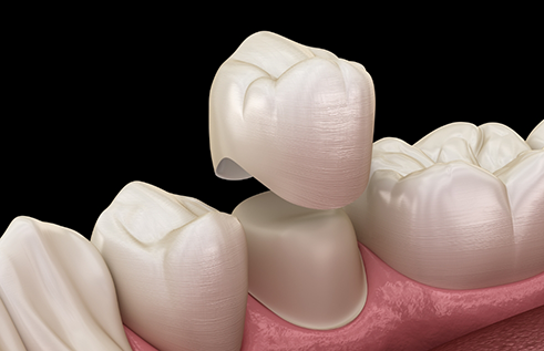 Illustration of a dental crown being fitted over a tooth