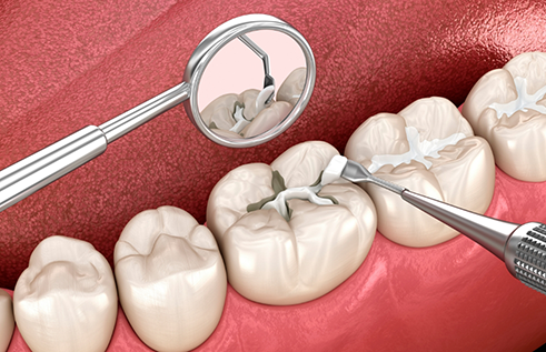 Illustration of a white filling being placed in a tooth