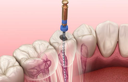 Illustration of a thin dental instrument treating the inner layer of a tooth