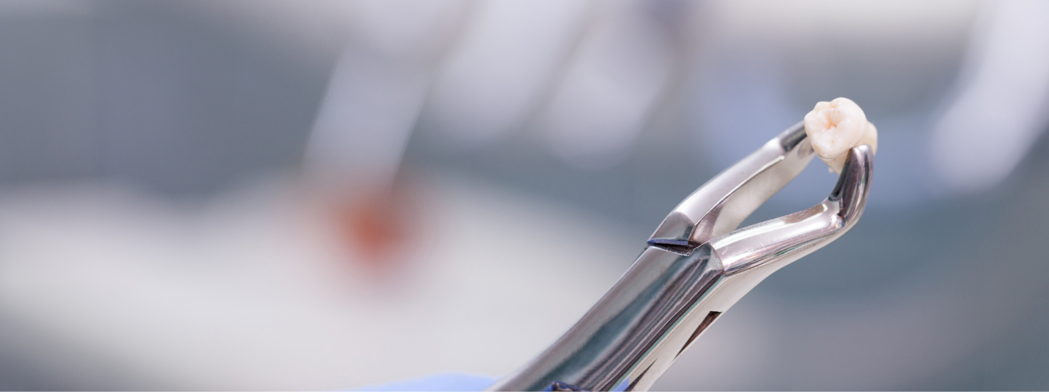 Dental clasp holding an extracted tooth