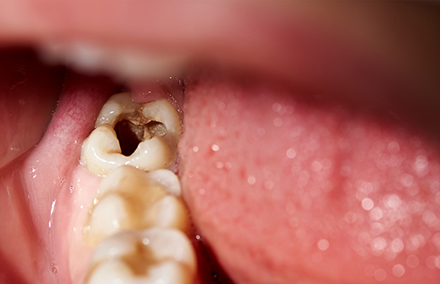 Close up of a severely decayed tooth in a mouth